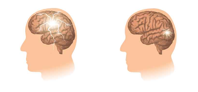 Can Keto Treat Epilepsy? Picture of a Brain Suffering From Epilepsy.