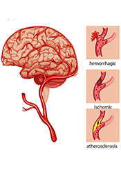 Higher Coffee Intake Lowers the Risk of Stroke, A Diagram Showing the Different Types of Stroke.